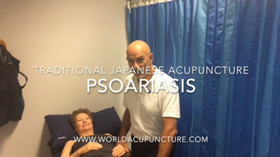 Psoriasis Treatment