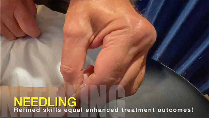 THE ART OF NEEDLING IN CLASSICAL ACUPUNCTURE