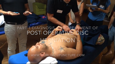 Acupuncture Diagnosis and Treatment for Post Operative Disc Herniation Part 1.