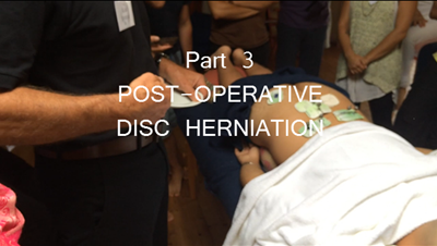 Post Operative Disc Herniation Part 3