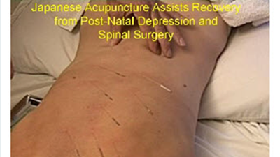 Treatment for Post-Natal Depression and Post Lumbar Surgery